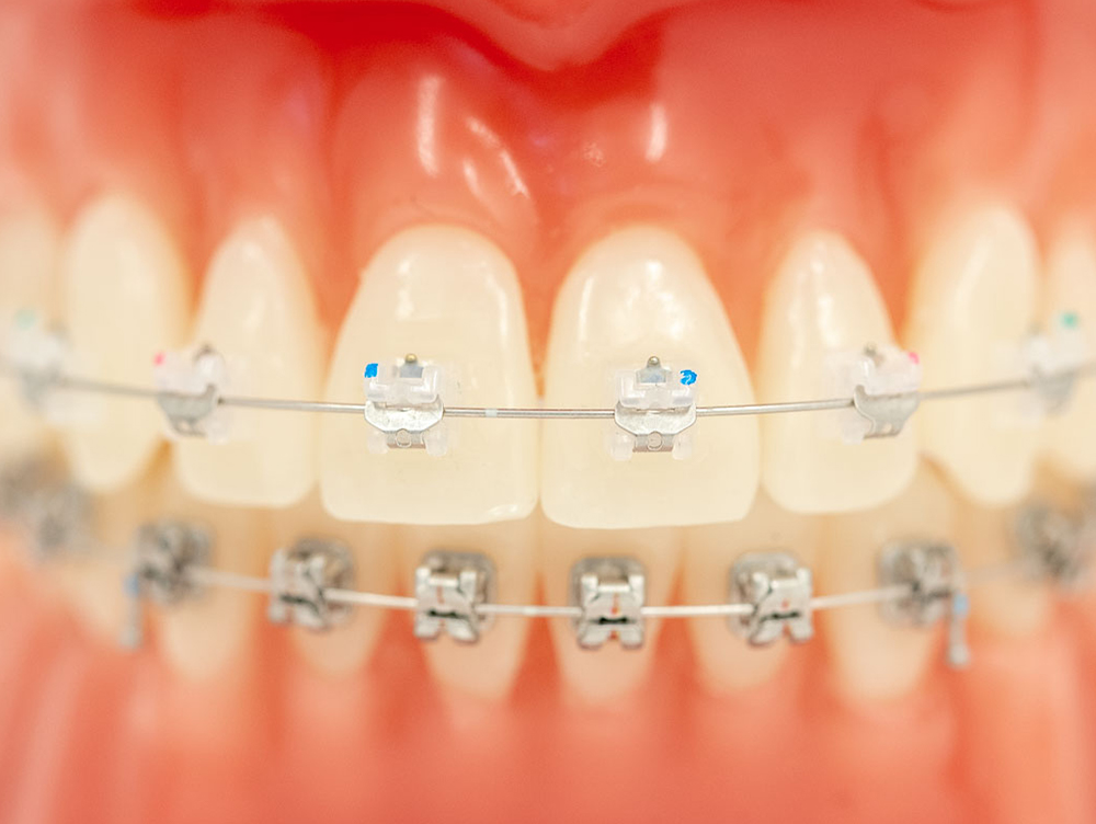 Feste Zahnspangen Dr. Raphael Hoehr Kieferorthopäde Borken Dr